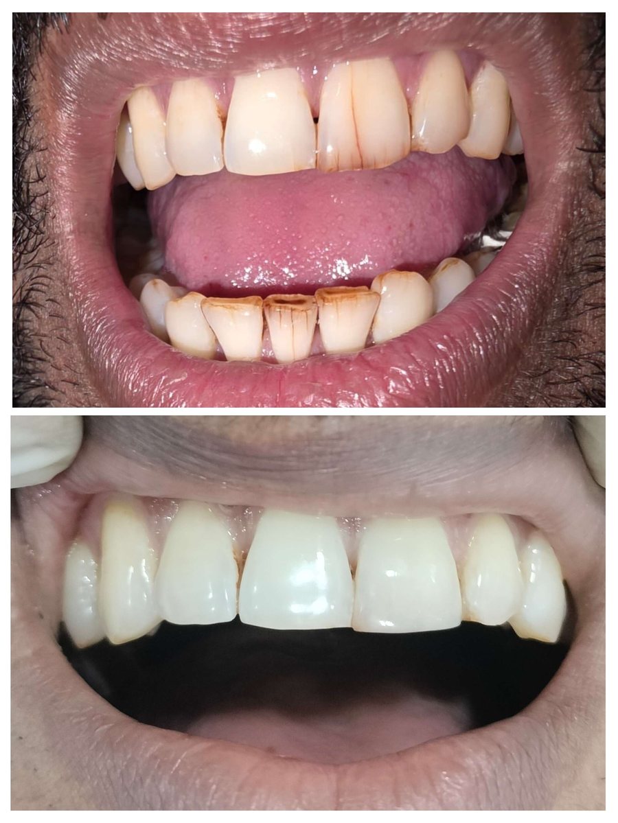 Before and after composite restoration